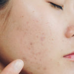 pbmt for post inflammatory hyperpigmentation