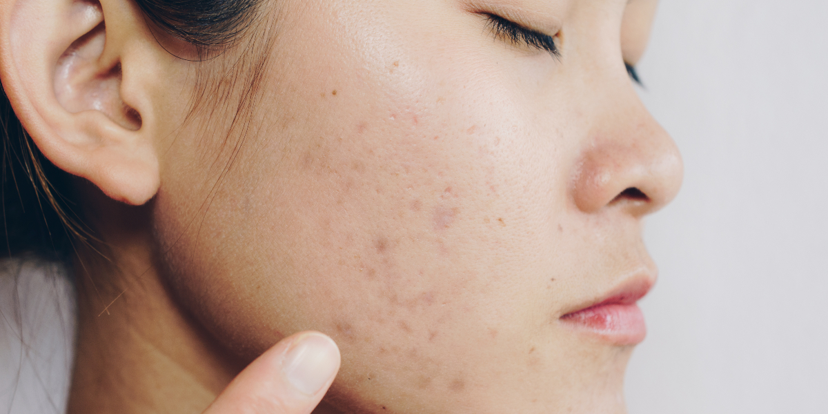 pbmt for post inflammatory hyperpigmentation